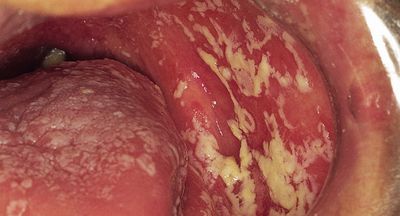 candidoza-sfdr7.jpg